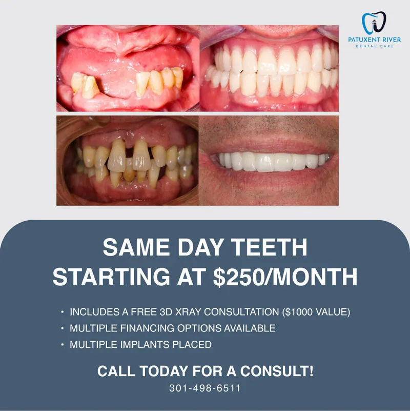 Same Day Teeth Special Offer